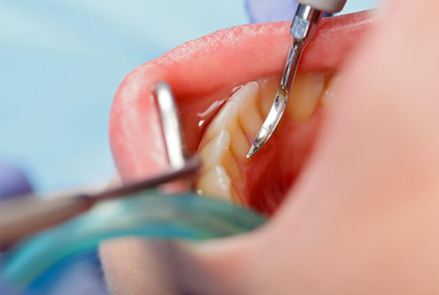 歯周検査（再評価）