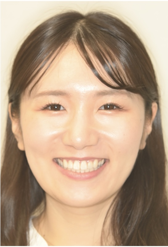 矯正治療後の笑顔